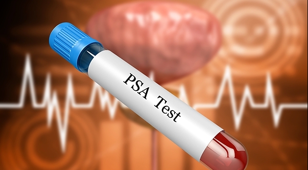 Med hjälp av PSA-test kan prostatacancer upptäckas redan innan sjukdomenn ger symptom, vilket ökar chanserna till en lyckad behandling.