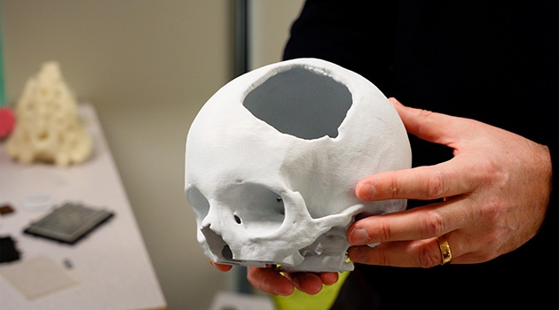 A skull with a severe skull injury was printed in 3D printers to facilitate the production of an implant.