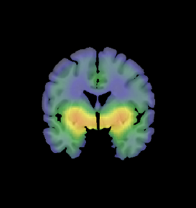 PET image of brain serotonin transporter availability in individuals with social anxiety disorder
