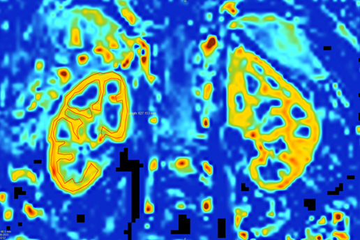 MRI image of kidneys.