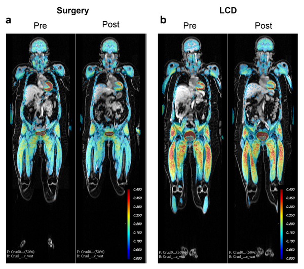 MRI-bild över mängden och fördelningen av fett i en människokropp före och efter gastric by pass operation.