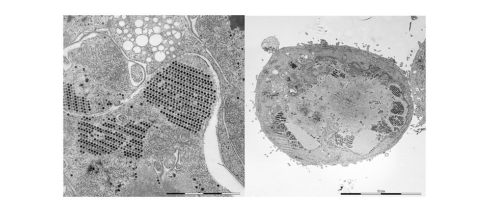 Two combined photos in black and white showing cancercells photographed under an electron microskope.