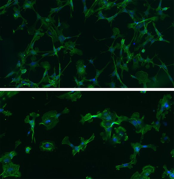 Mikroskopibilder på odlade hjärntumörceller färgade i grönt och blått