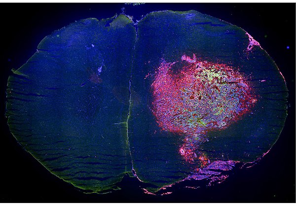 Mikroskopibild av en mushjärna med hjärntumör där olika celler har olika färg.